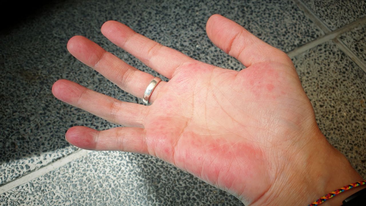 Lupus