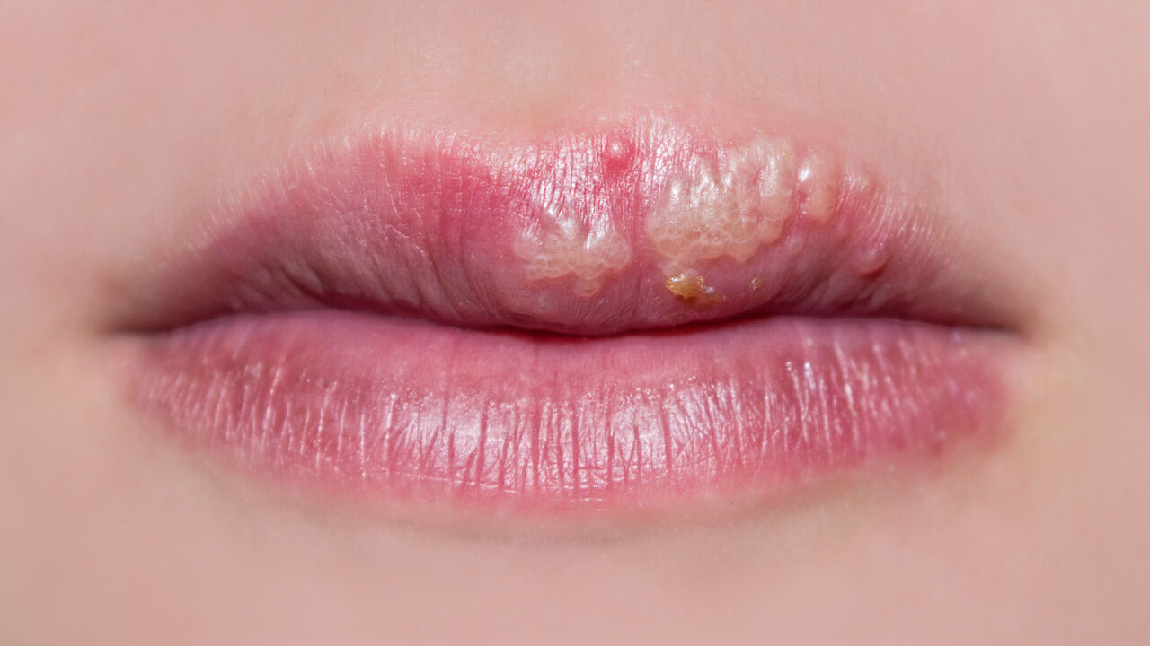 herpes
