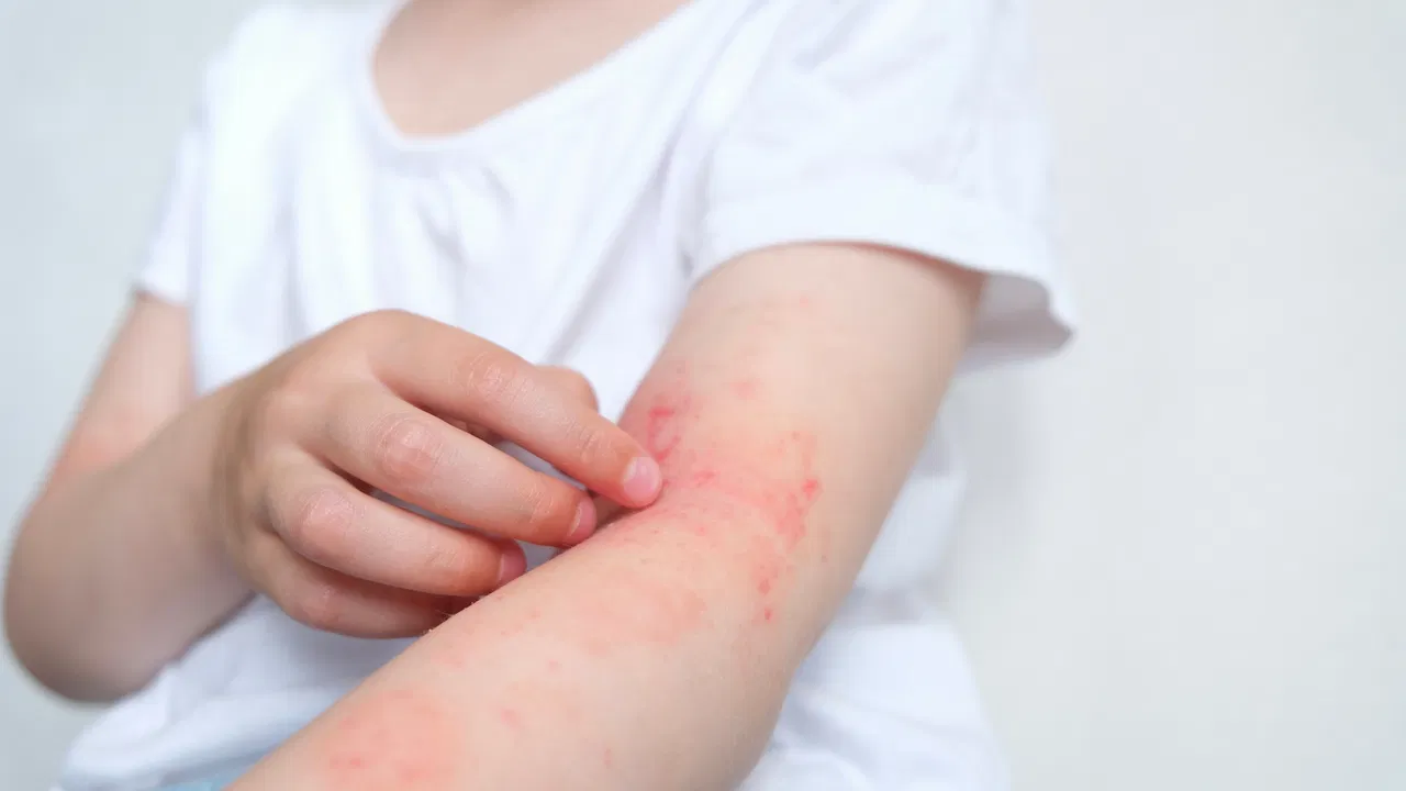 Atopijski dermatitis