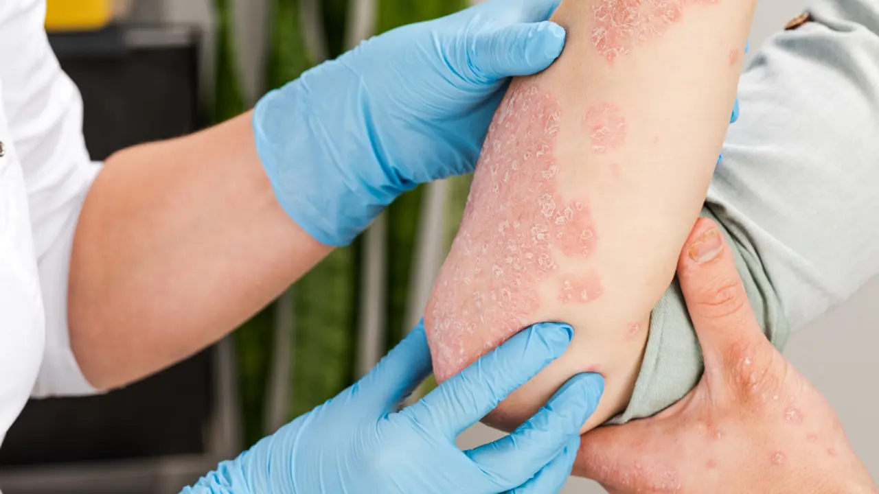 psorijaza
