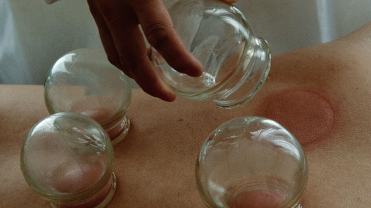 cupping terapija, staklene čaše