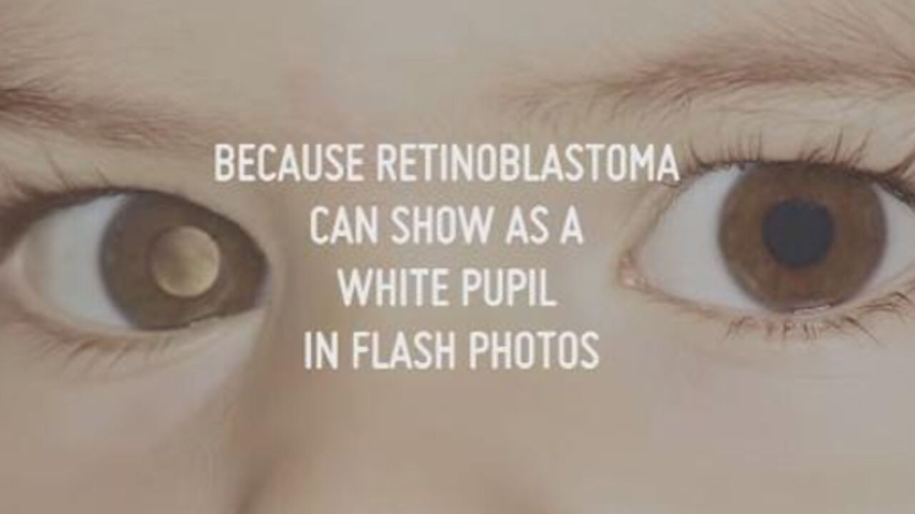 Retinoblastom