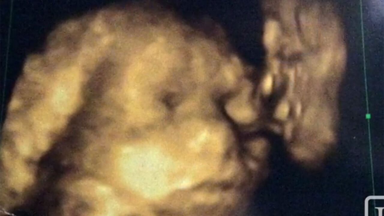 Ultrazvuk bebe