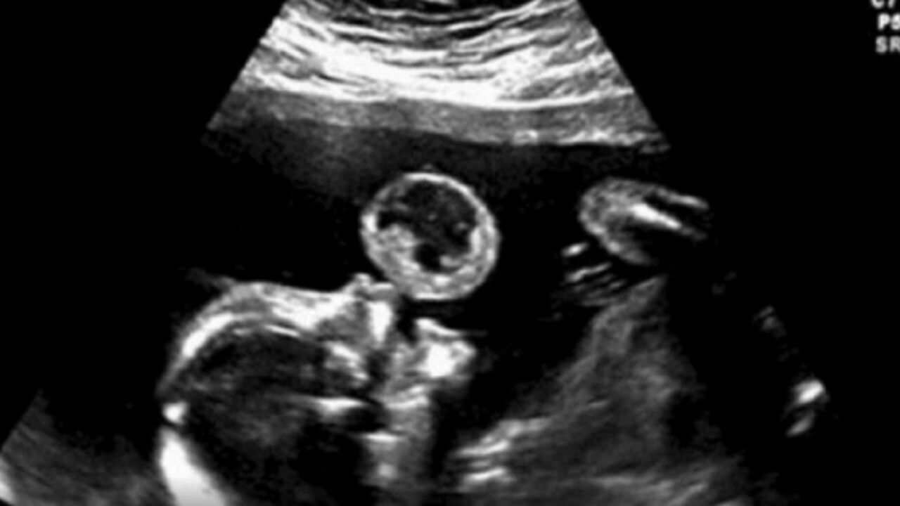 Ultrazvuk bebe koja duva balon