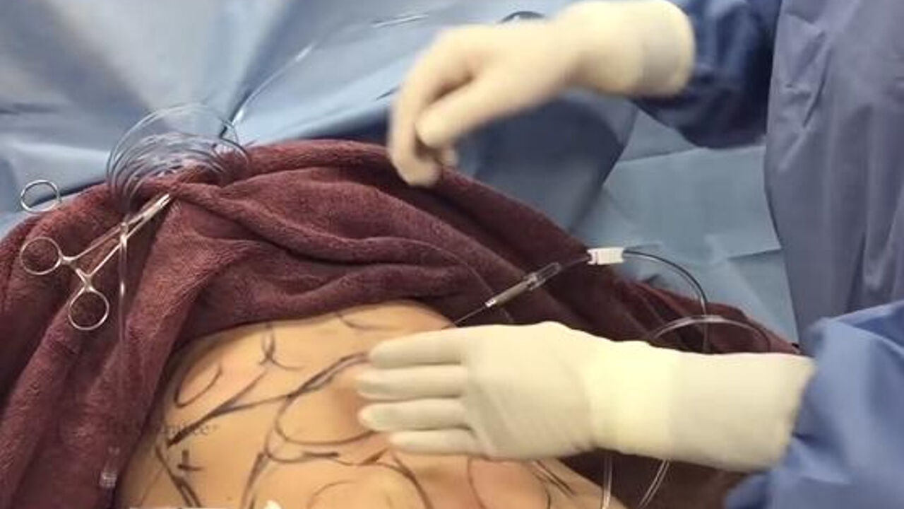 Liposukcija