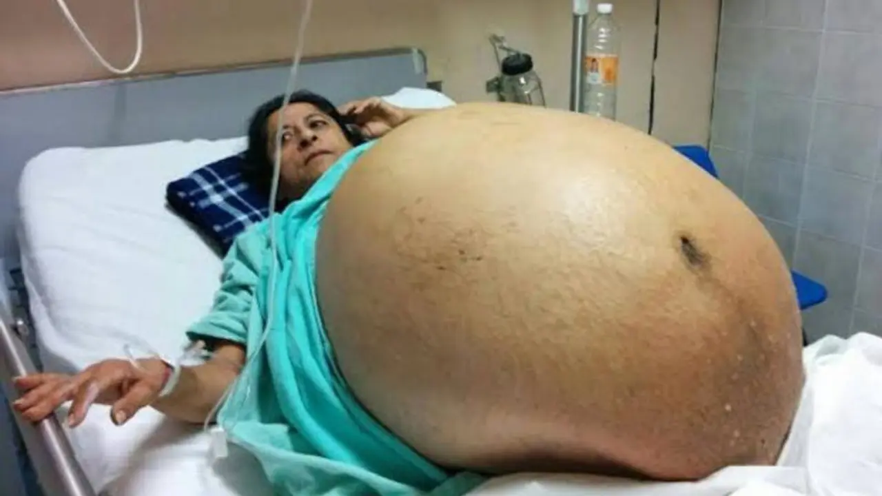žena sa tumorom