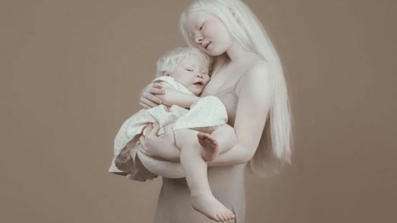 Albino blizanci