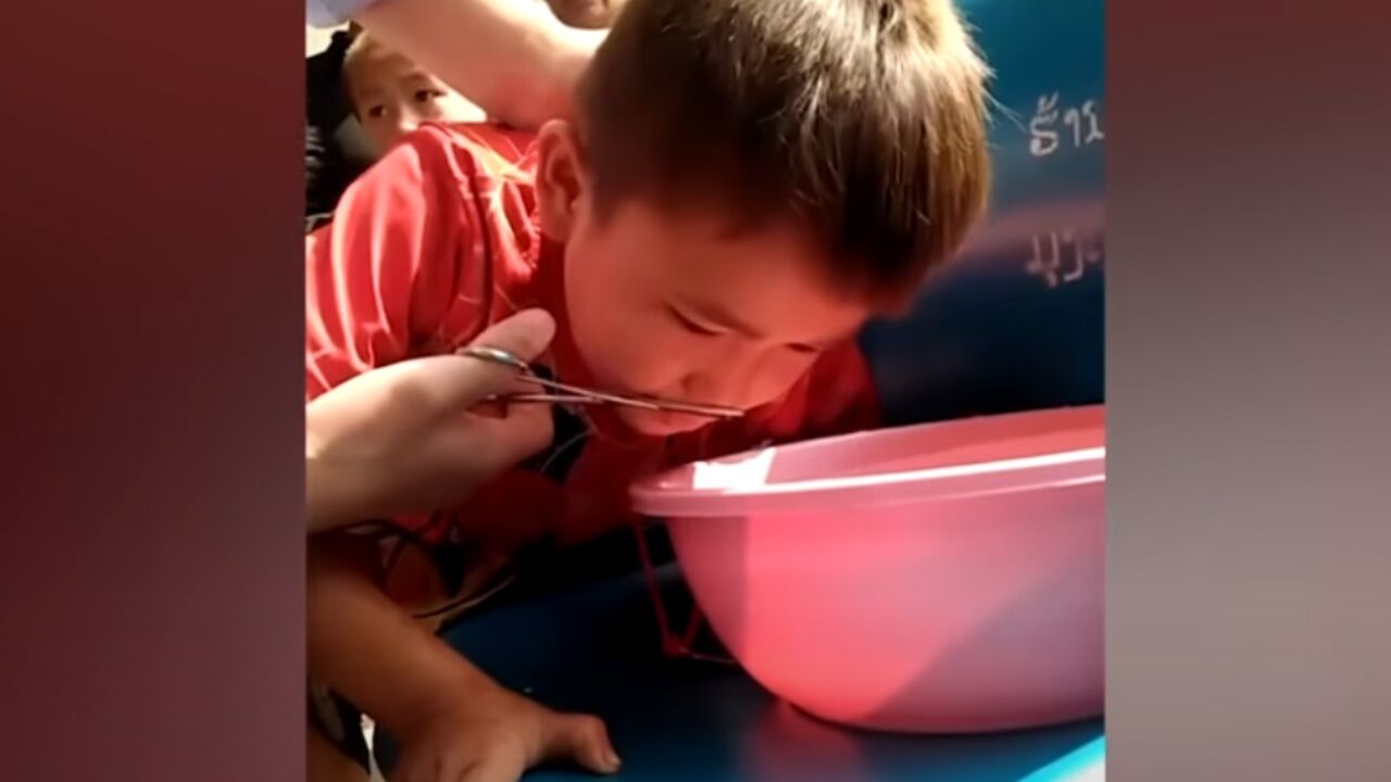 pijavica u dečakovom nosu