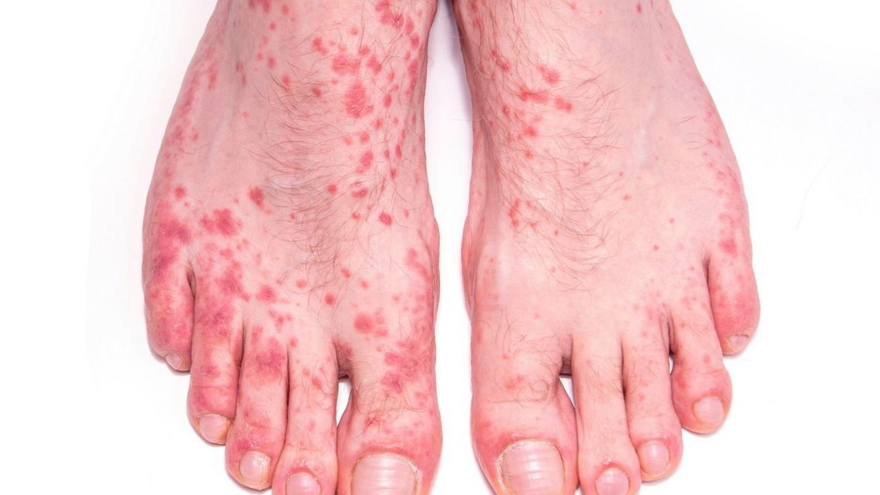 psorijaza