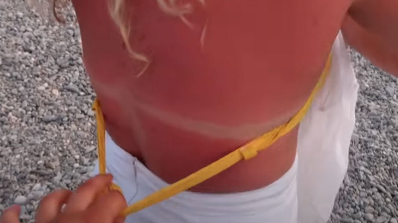 Izgorela na suncu
