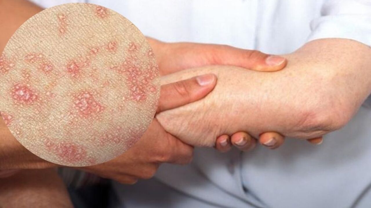 lihen planus