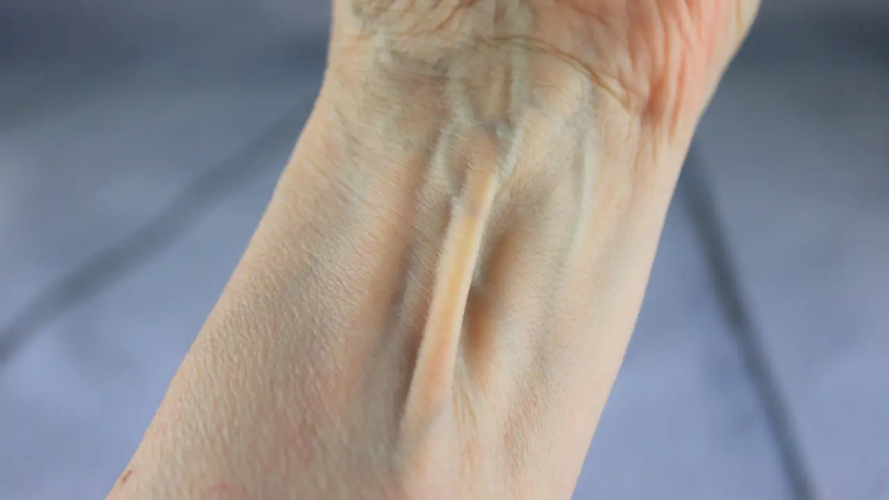 Palmaris longus